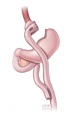 gastric_bypass-1