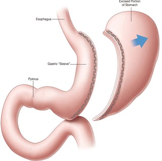 sleeve-gastrectomy